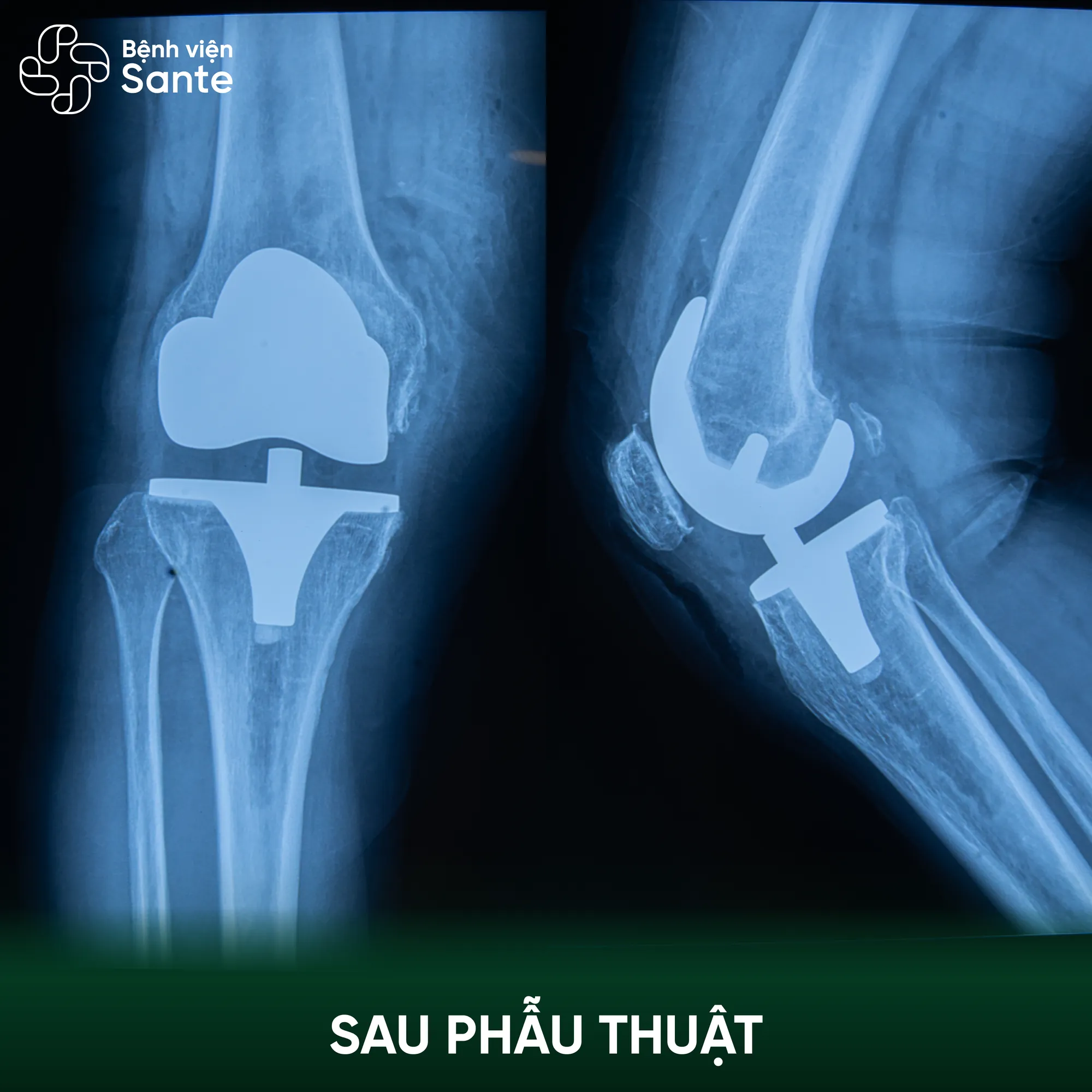Postoperative radiograph following total knee arthroplasty at Sante Hospital