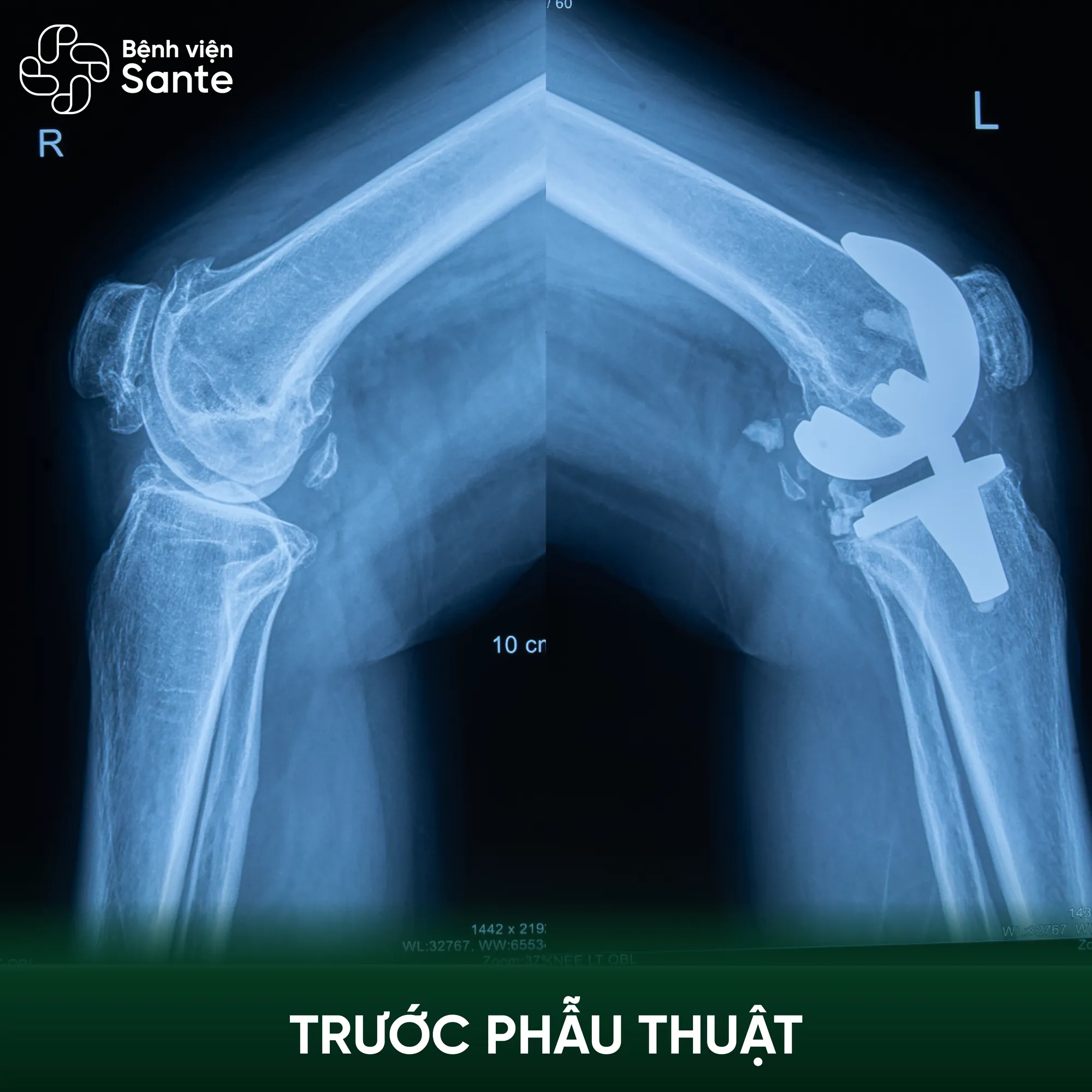 Preoperative bilateral knee X-ray of patient Huong demonstrating advanced osteoarthritis at Sante Hospital