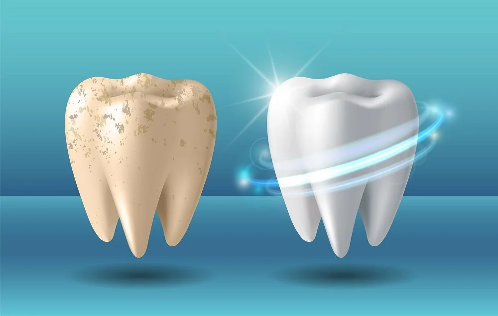 Sante Hospital - Teeth Whitening (Image 2) Sante Hospital - Teeth Whitening (Image 2)