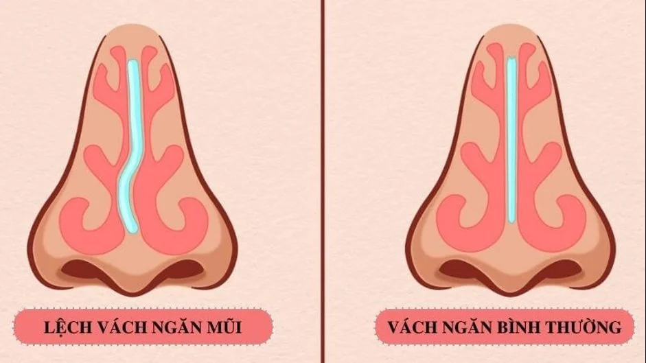 Sante Hospital - DEVIATED NASAL SEPTUM: WHEN IS SURGERY REQUIRED ? (Figure 2)