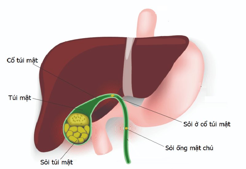 Sỏi túi mật